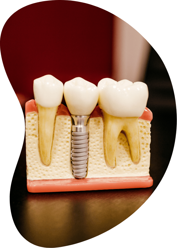 Cemisa implantologia a Torino, impianto dentale a Torino, quanto dura un impianto dentale