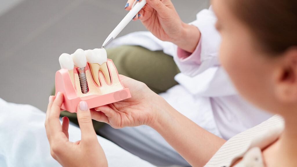 Impianti dentali a carico immediato: tutti i vantaggi