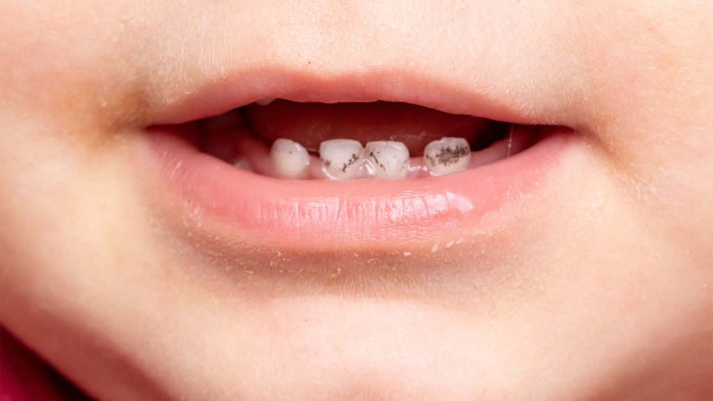 Foto di dettaglio della bocca di un bambino con le black stain sui dentini