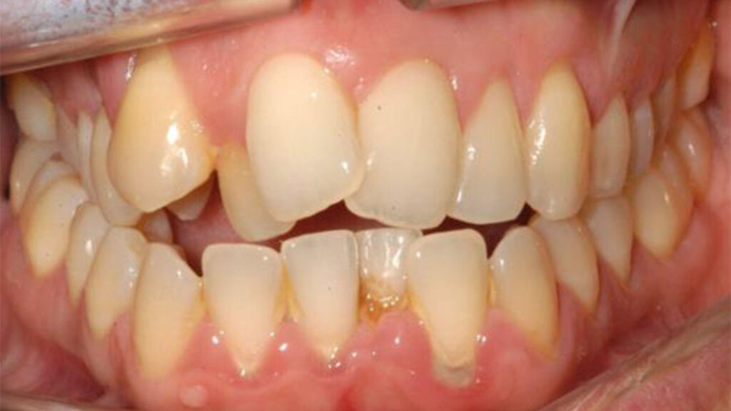 Foto di un caso complesso di malocclusione, prima del trattamento di ortodonzia in Studio Cemisa